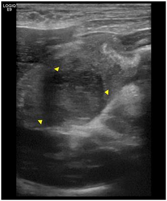 Case report: Surgical treatment of pyloric obstruction with intramural gastric abscess induced by fragmented crystalline foreign materials in a dog